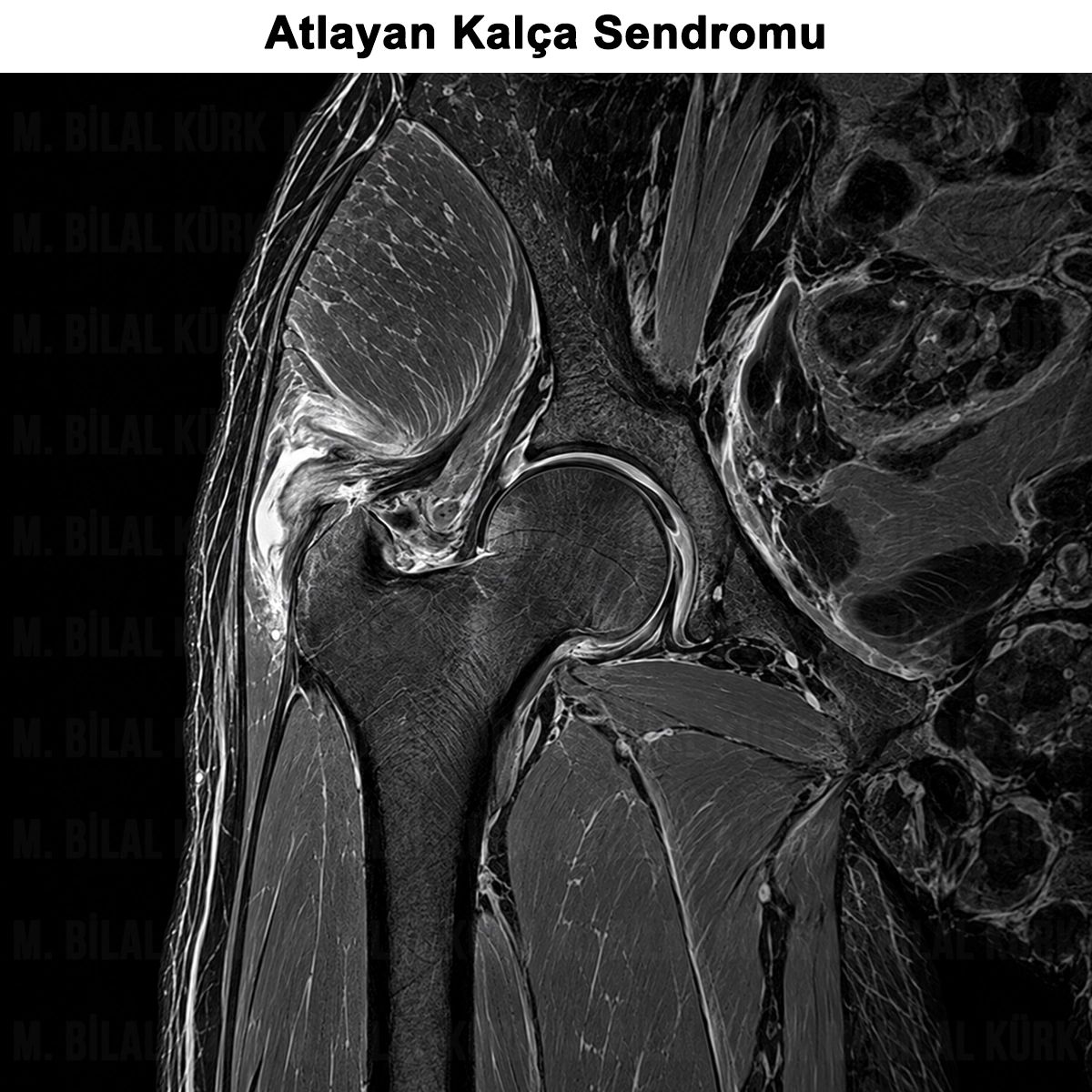 Atlayan Kalça Sendromu: Çeşitleri, Belirtileri ve Tedavisi