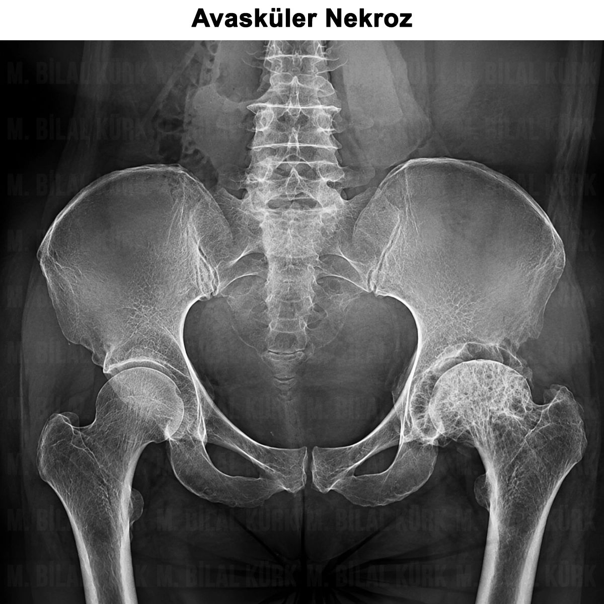 Kalça Avasküler Nekrozu: Evreleri, Tedavisi ve Ameliyatı