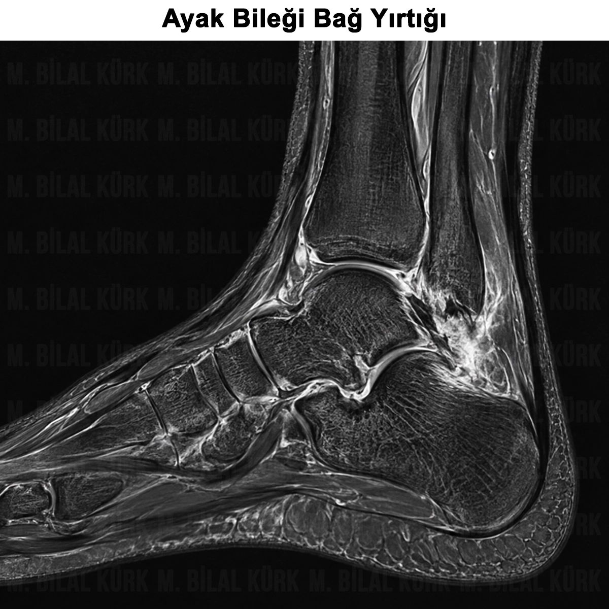 Ayak Bileği Bağ Yırtığı (ATFL): Belirtileri ve Tedavisi
