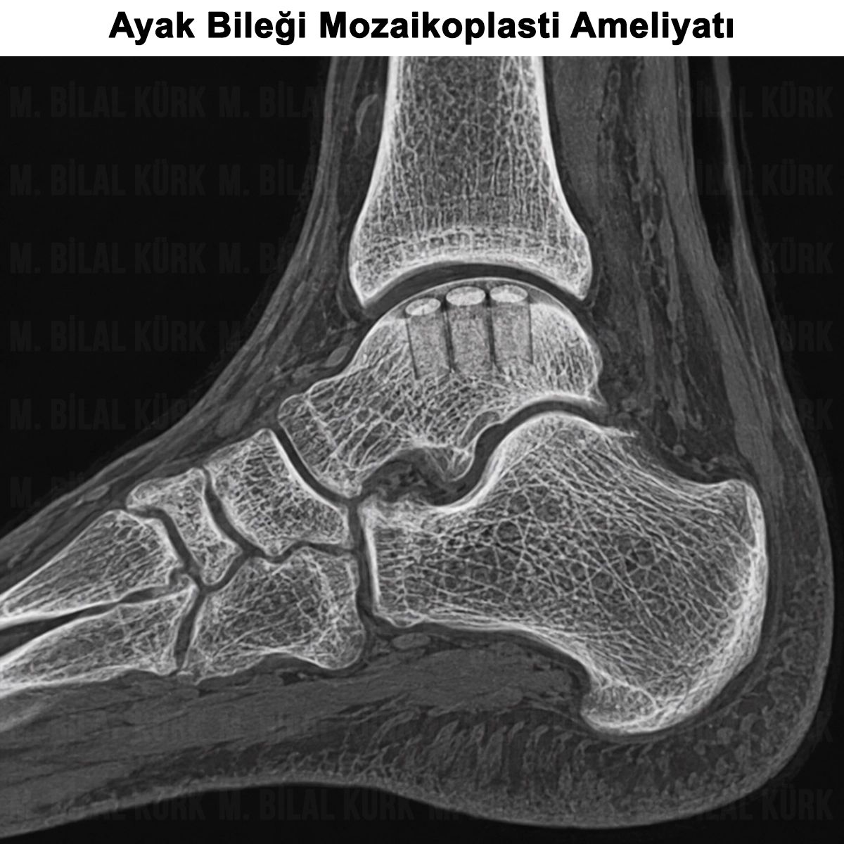 Ayak Bileği Mozaikoplasti Ameliyatı: Nedir? Nasıl Yapılır?