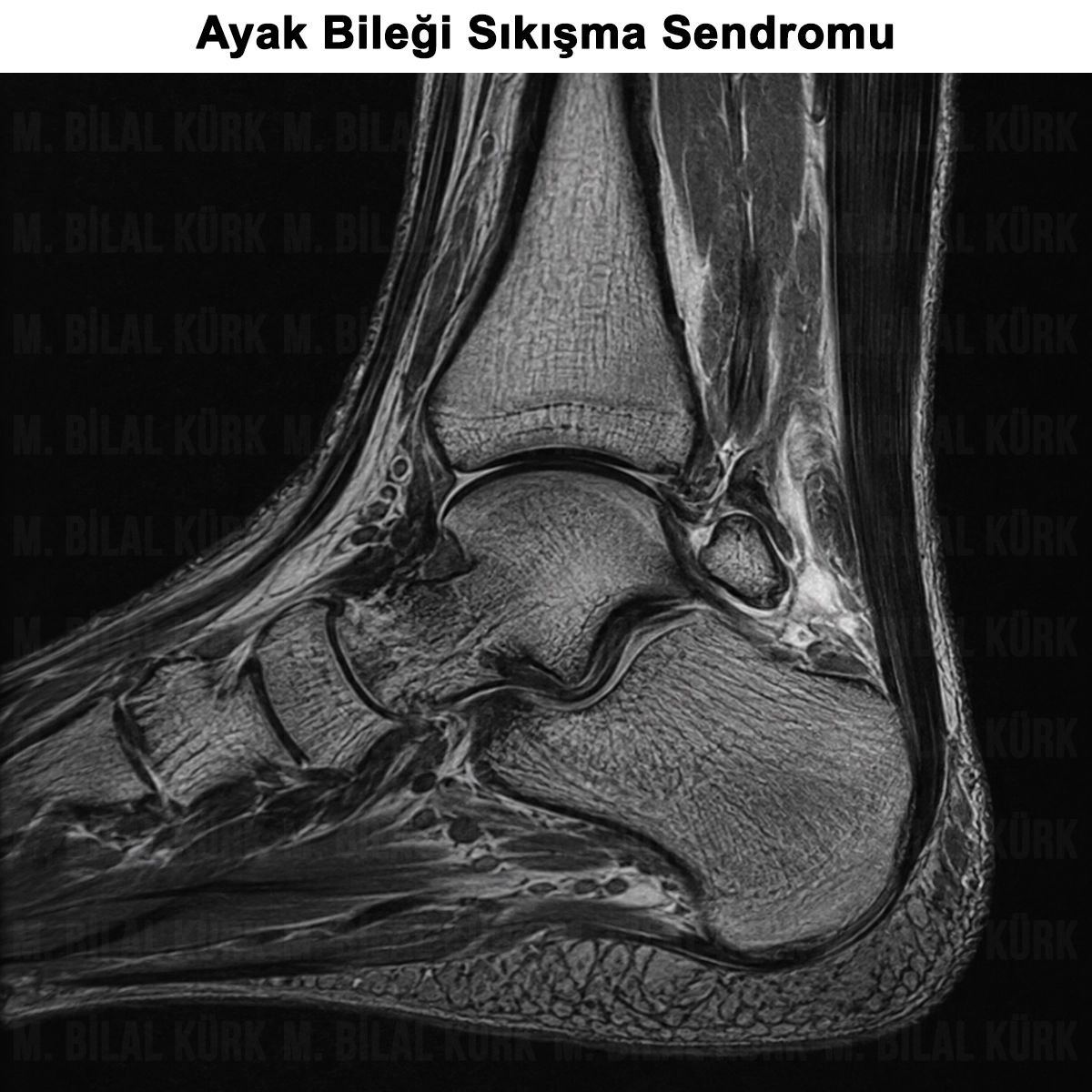 Ayak Bileği Sıkışma Sendromu: Belirtileri ve Ameliyatı
