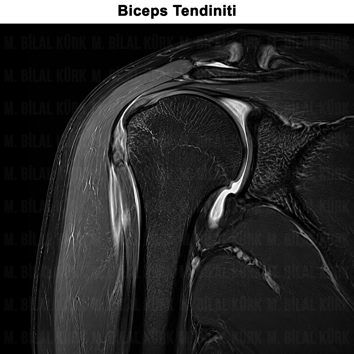 Biceps Tendiniti: Nedir? Belirtileri? Teşhis ve Ameliyat