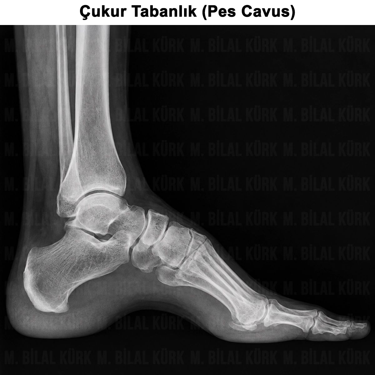 Çukur Tabanlık (Pes Cavus): Belirtileri, Teşhisi ve Tedavisi