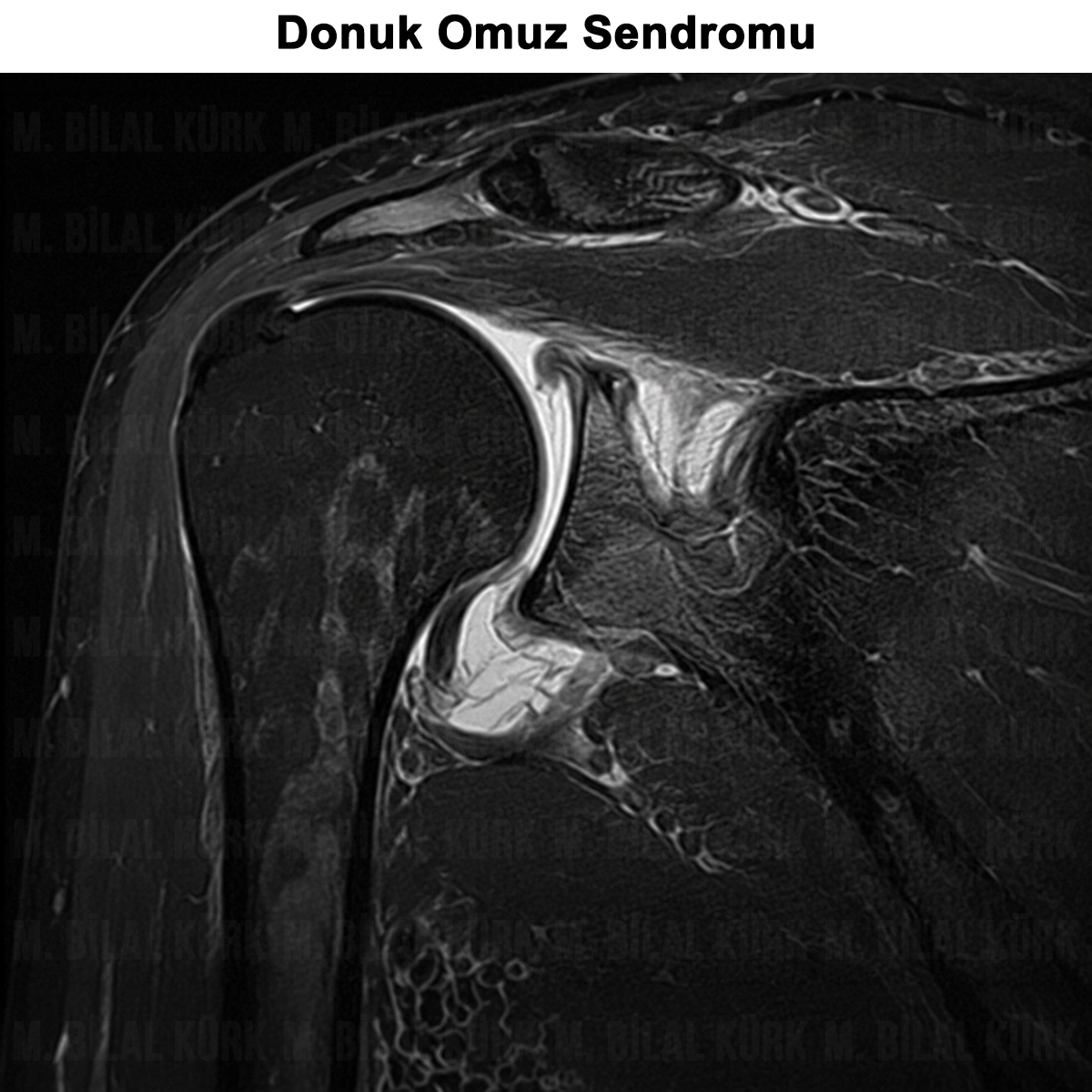 Donuk Omuz: Nedir? Neden Olur? Evreleri? Tedavi?