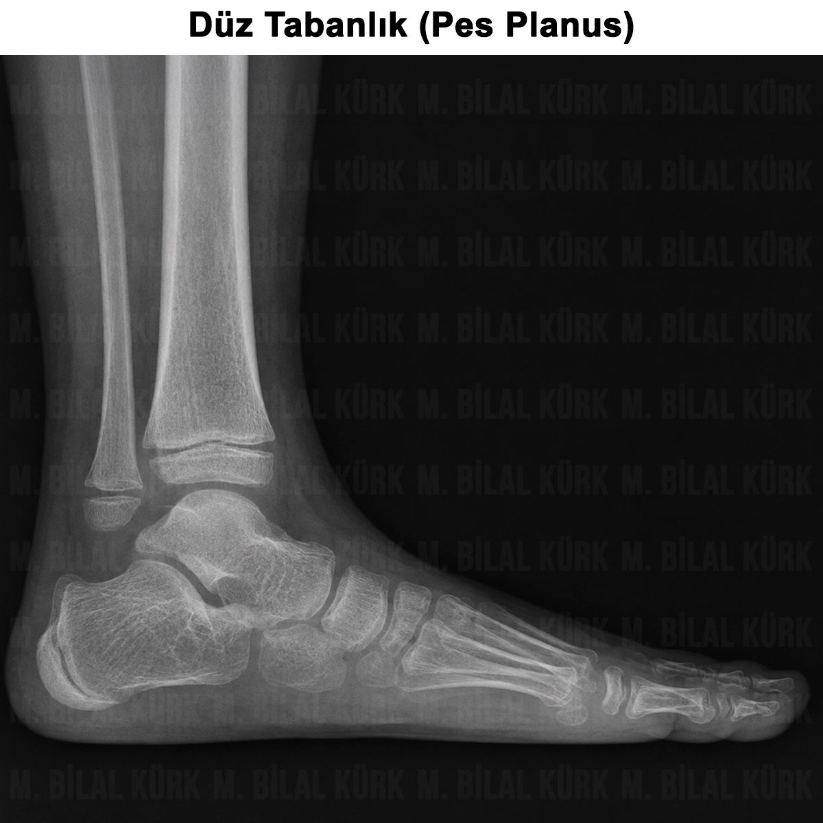 Çocuklarda Düz Tabanlık (Pes Planus): Teşhisi ve Tedavisi