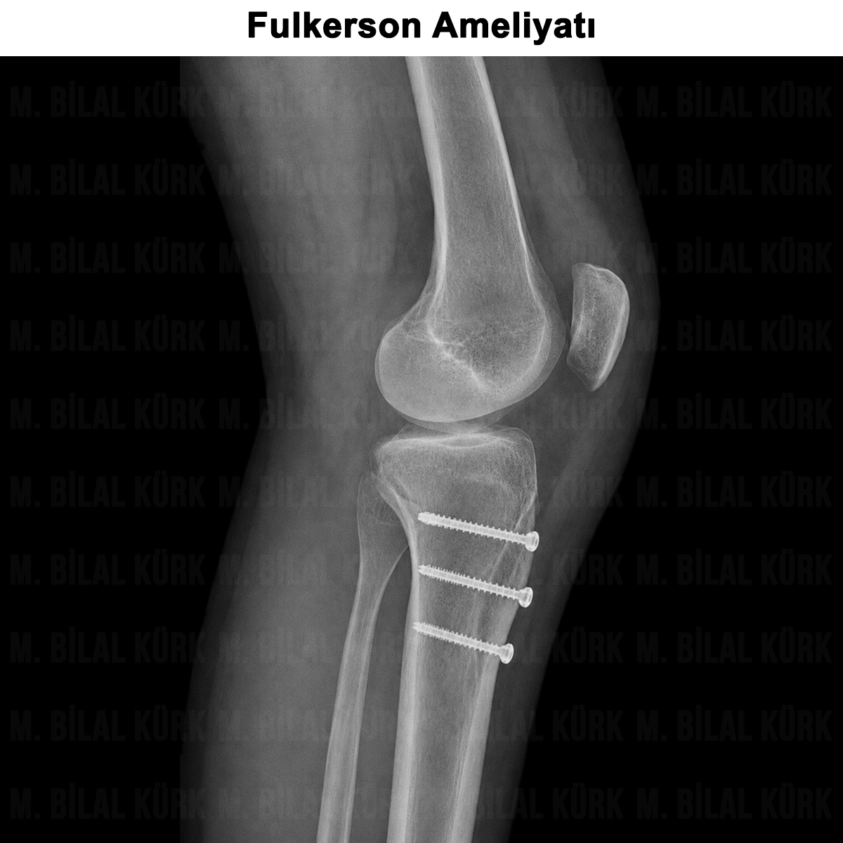 Fulkerson Ameliyatı: Kimlere Yapılır? Nasıl Karar Verilir?