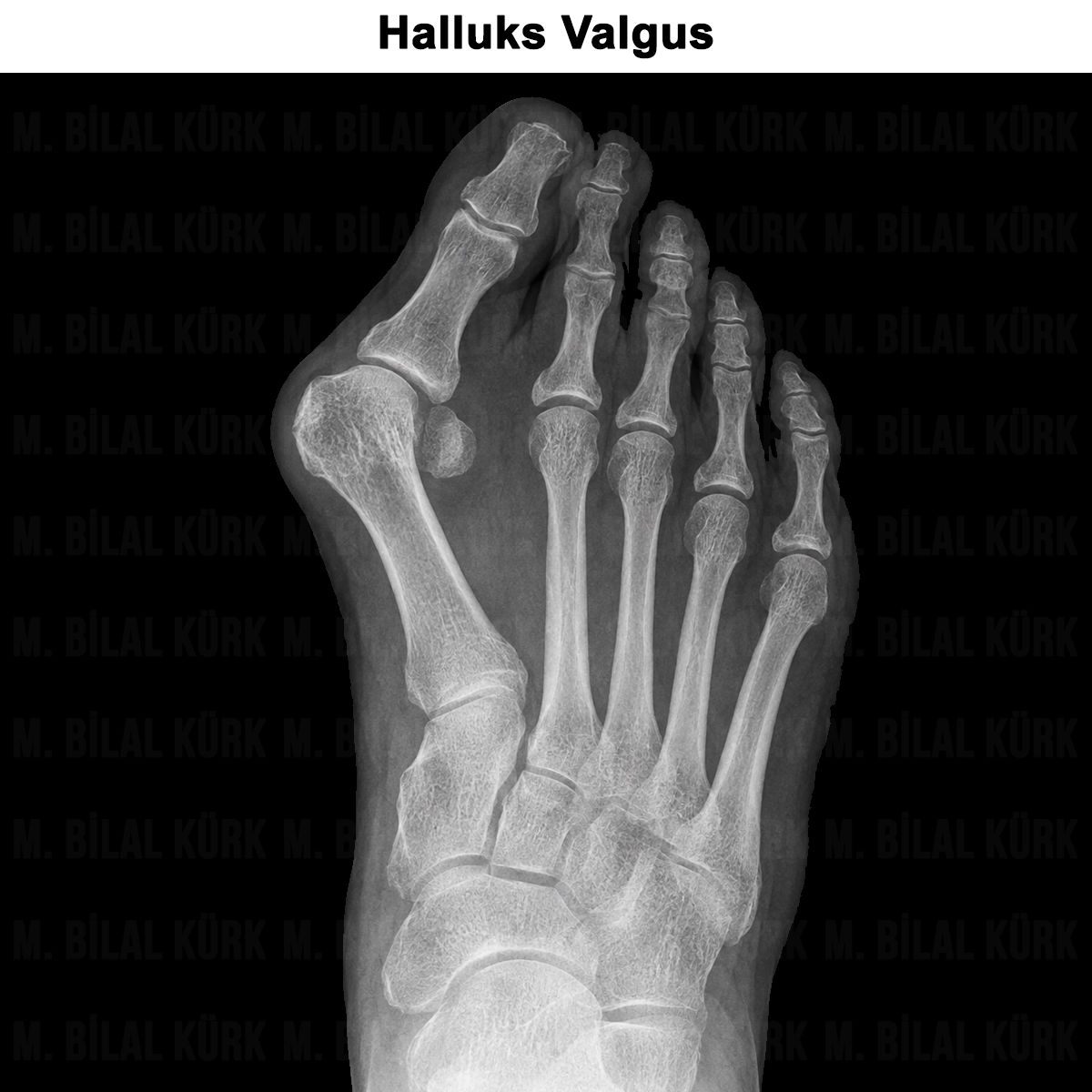 Halluks Valgus: Nedir? Nedenleri, Belirtileri ve Ameliyatı