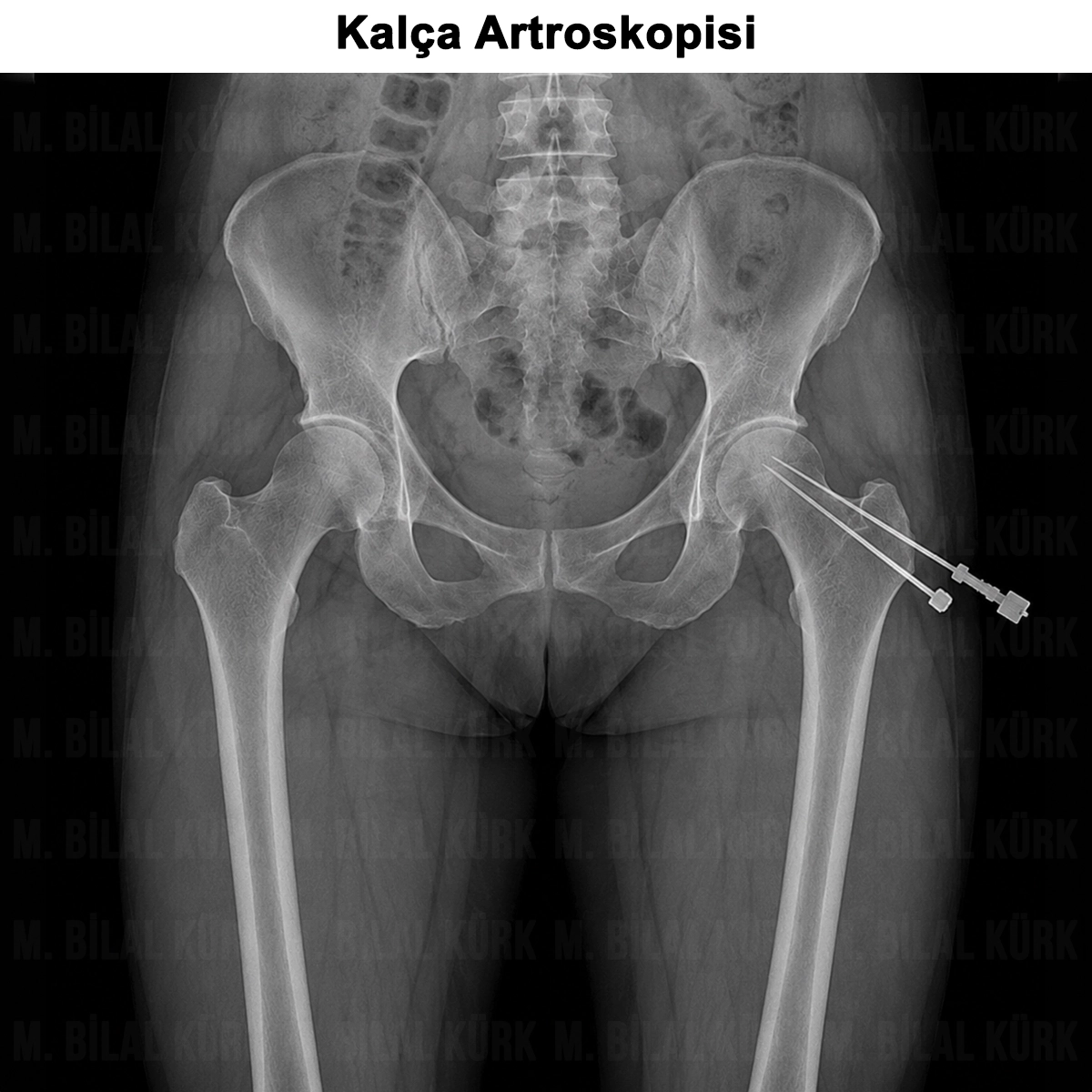 Kalça Artroskopisi: Nedir? Nasıl Yapılır? Riskleri?
