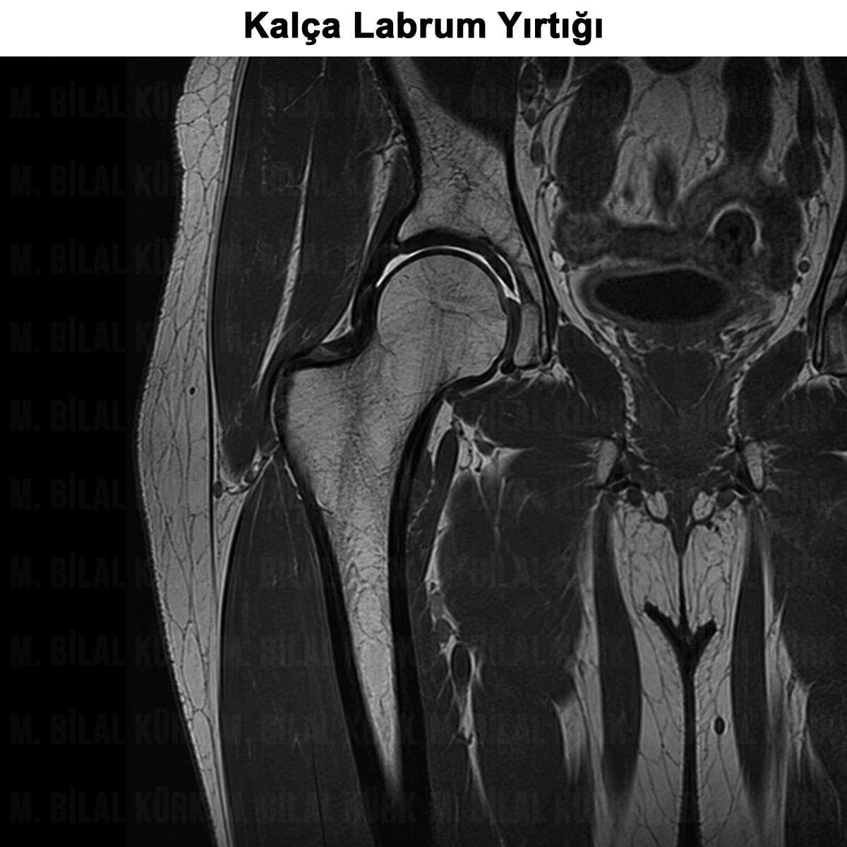 Kalça Labrum Yırtığı: Nedir? Neden Yırtılır?