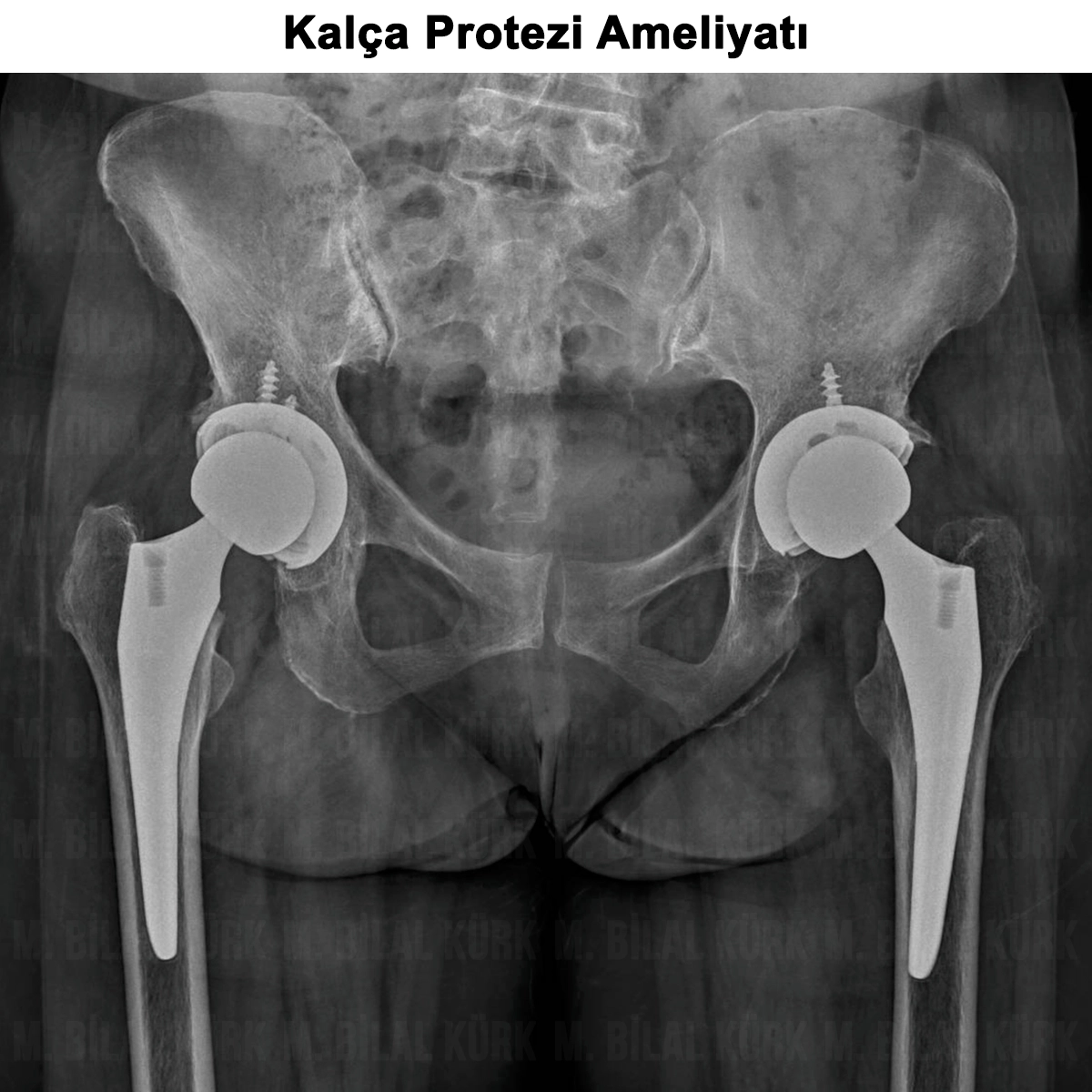 Kalça Protezi Ameliyatı: Nedir? Kimlere Yapılır? Sonrası?