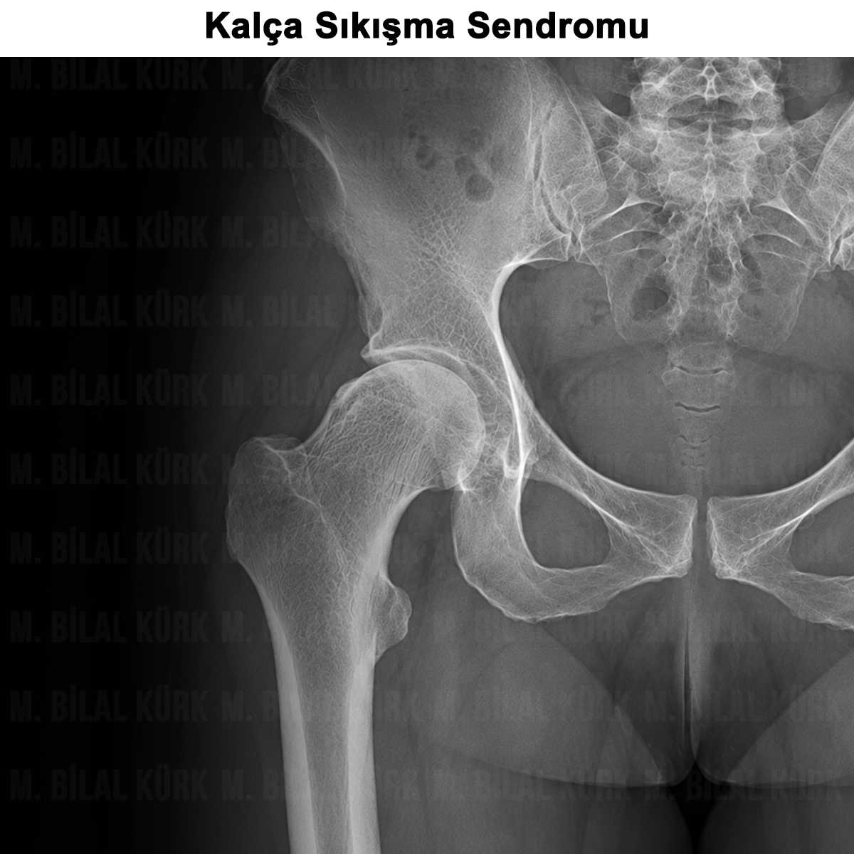 Kalça Sıkışma Sendromu: Nedir? Belirtileri? Tedavisi?