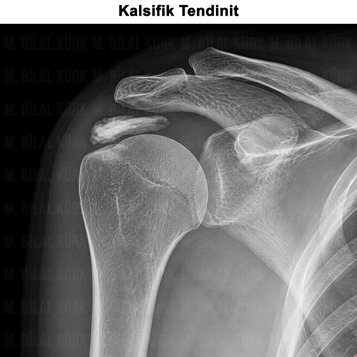 Kalsifik Tendinit: Nedir? Neden Olur? Ameliyatı?