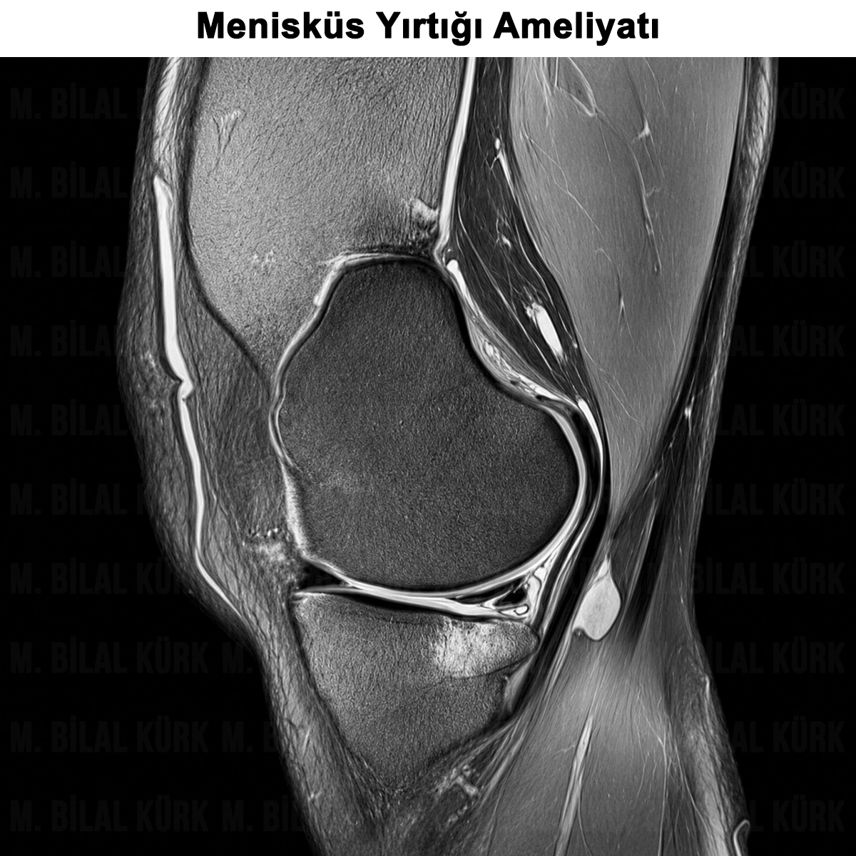 Menisküs Yırtığı: Neden Olur? Ameliyatı Nasıl Yapılır?