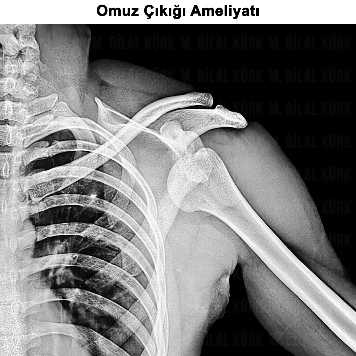 Omuz Çıkığı: Nedir? Belirtileri, Ameliyatı ve İyileşme
