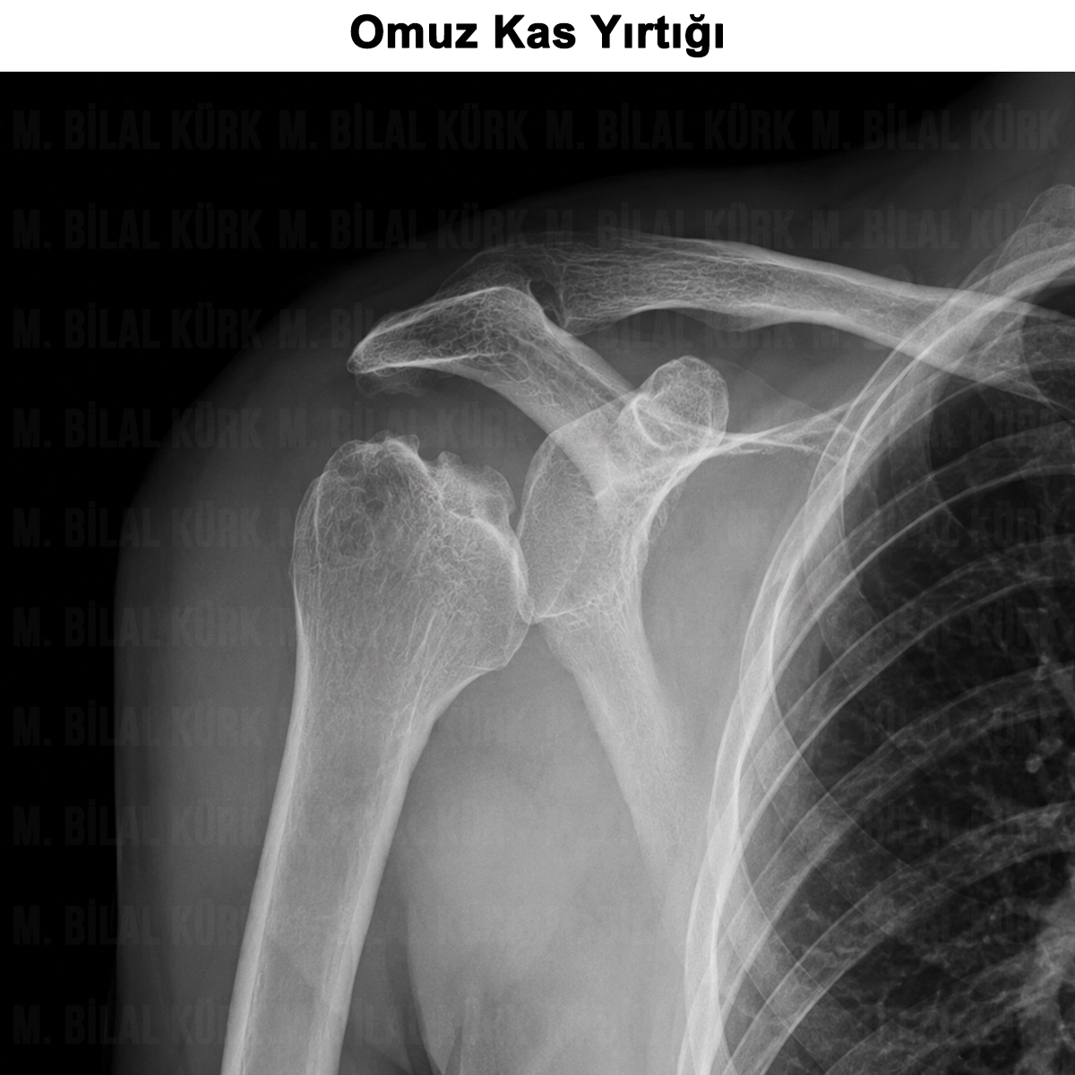 Omuz Tendon (Rotator Cuff) Yırtığı: Nedir? Neden Olur?