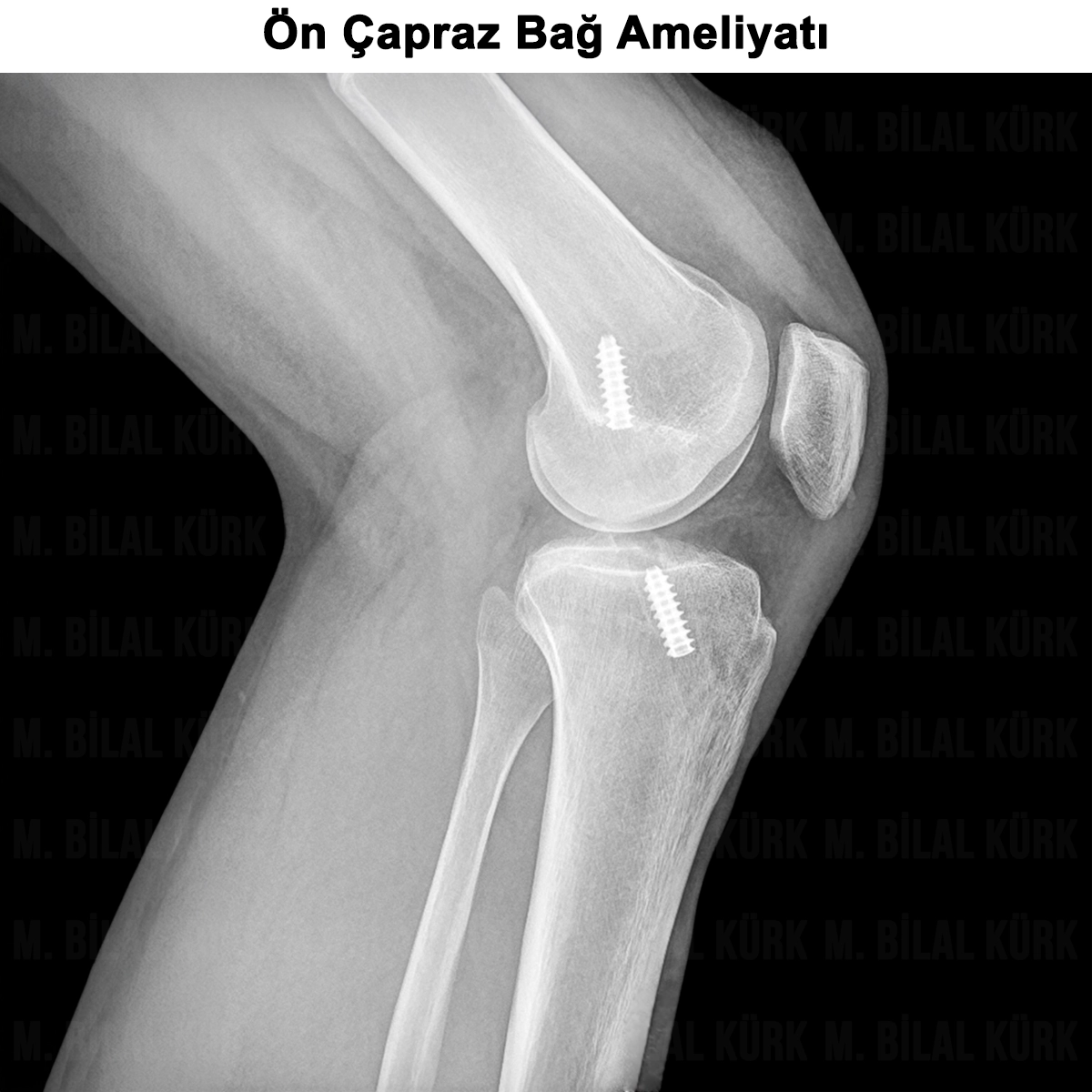 Ön Çapraz Bağ Ameliyatı: Tedavisi ve Ameliyatı