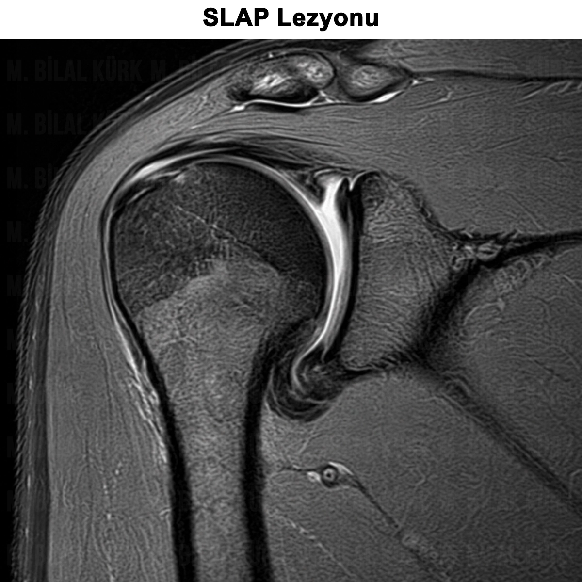 SLAP Lezyonu: Nedir? Belirtileri? Teşhis ve Ameliyat