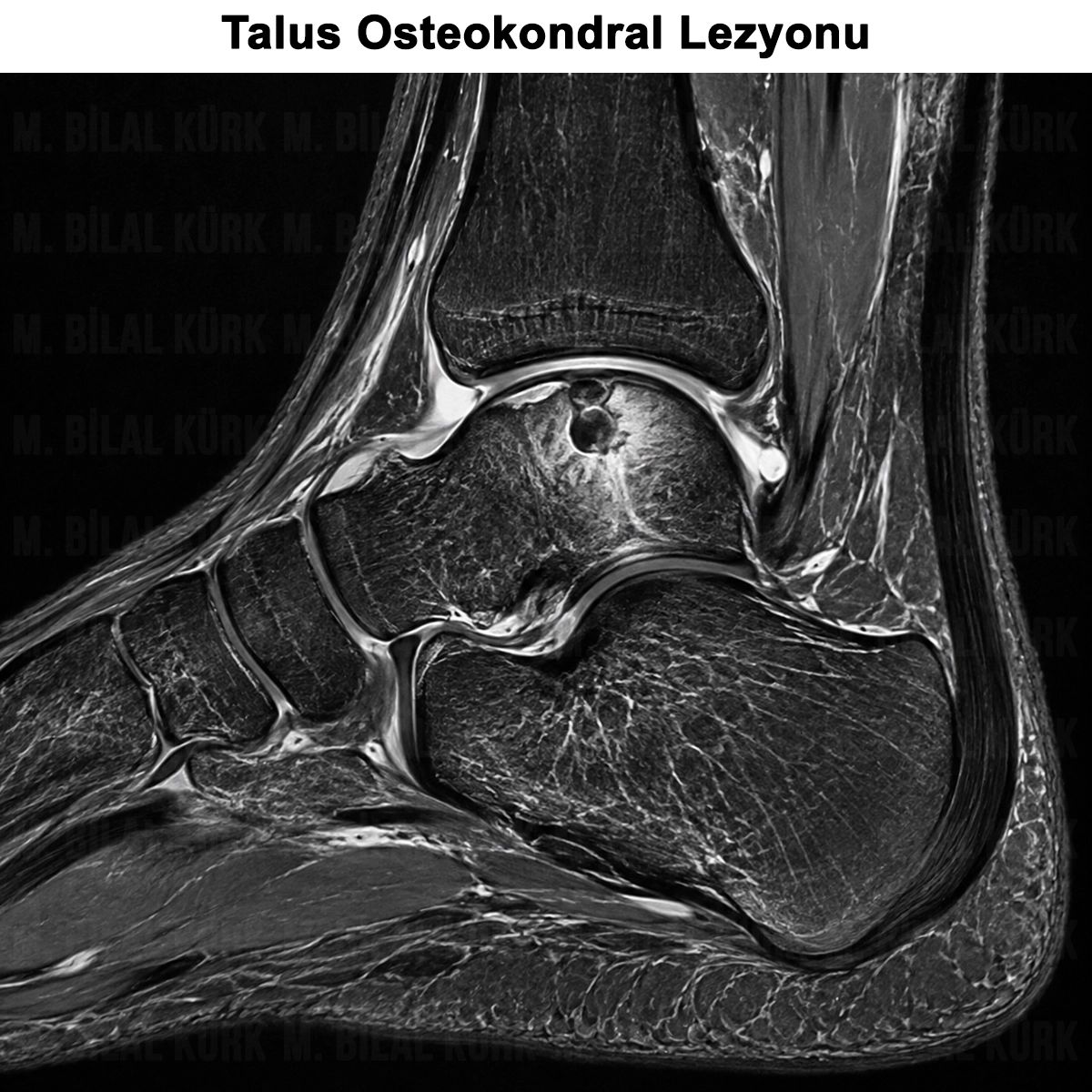 Talus Osteokondral Lezyonu: Belirtileri, Teşhisi, Ameliyatı