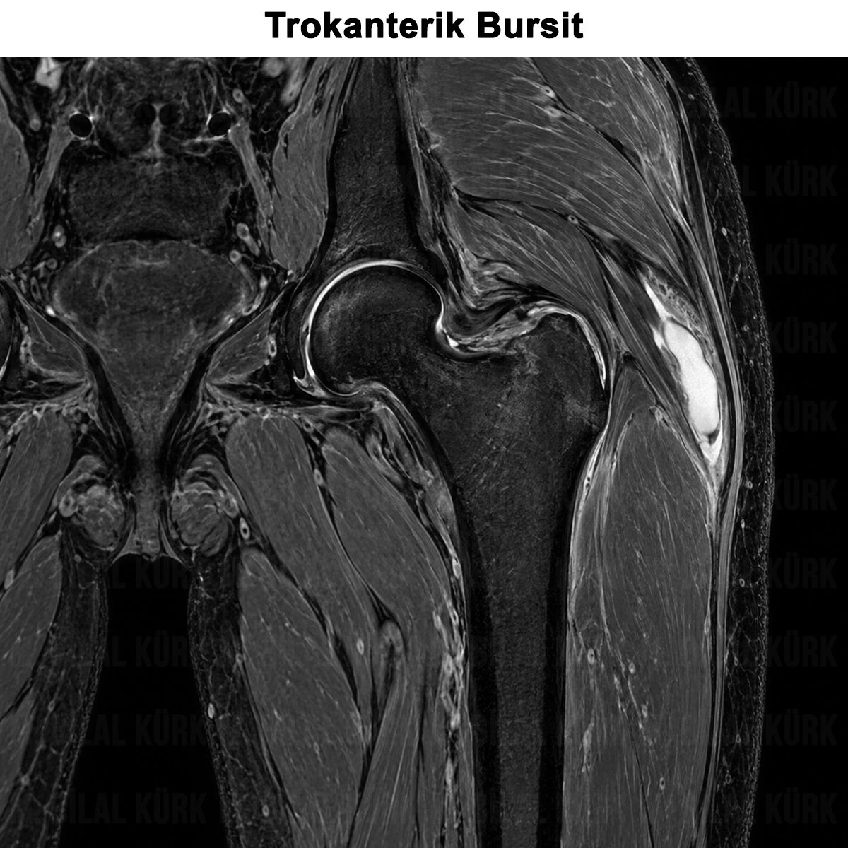 Trokanterik Bursit: Nedir? Nedenleri, Belirtileri, Tedavisi