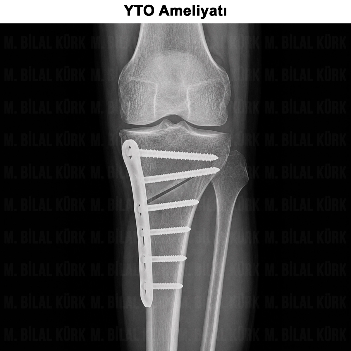 YTO Ameliyatı: Nedir? Kimlere Yapılır? Nasıl Yapılır?